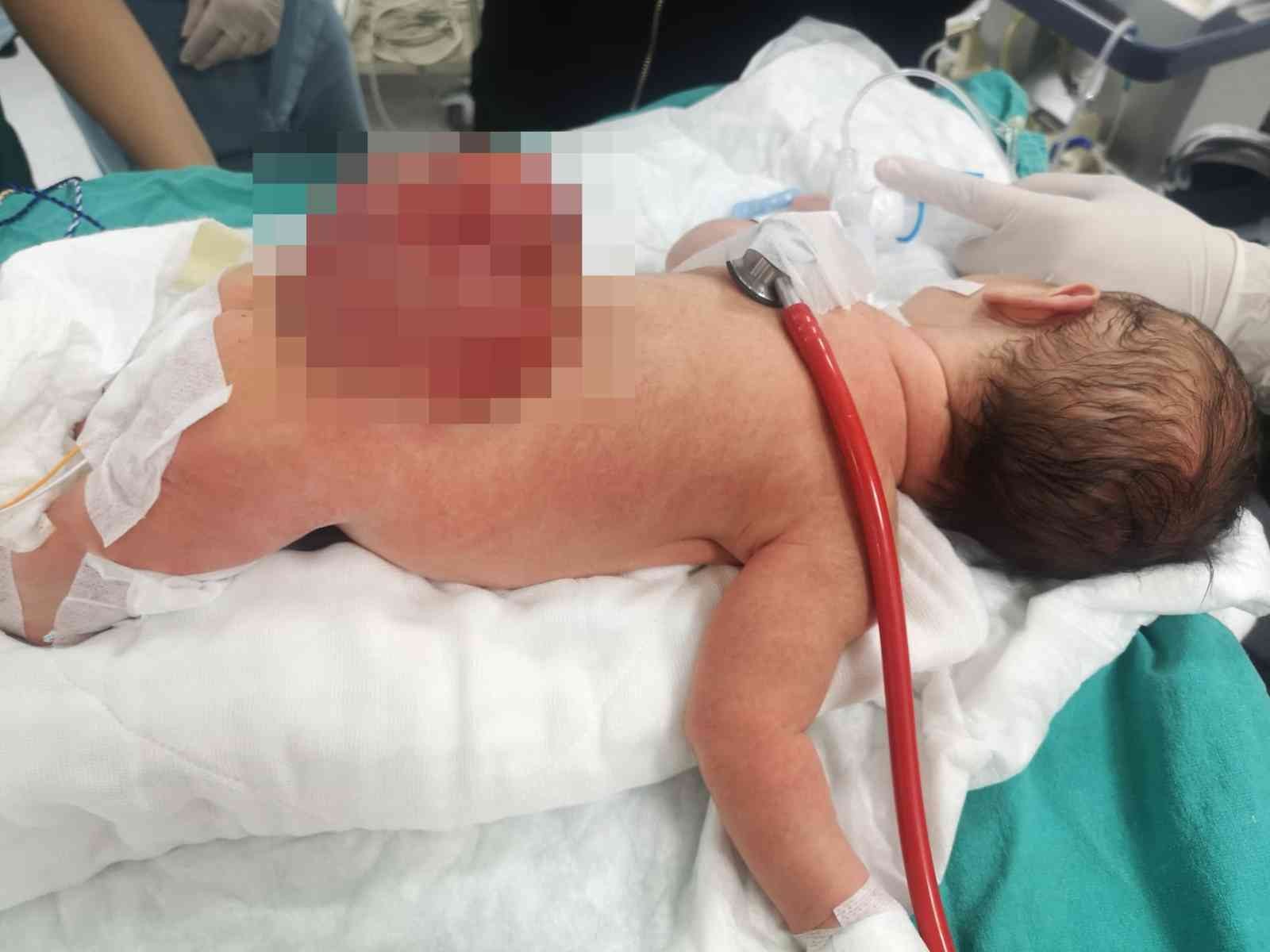 Açık omurga ile doğdu