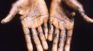 Maymun Çiçeği  Virüsü Türkiye'de